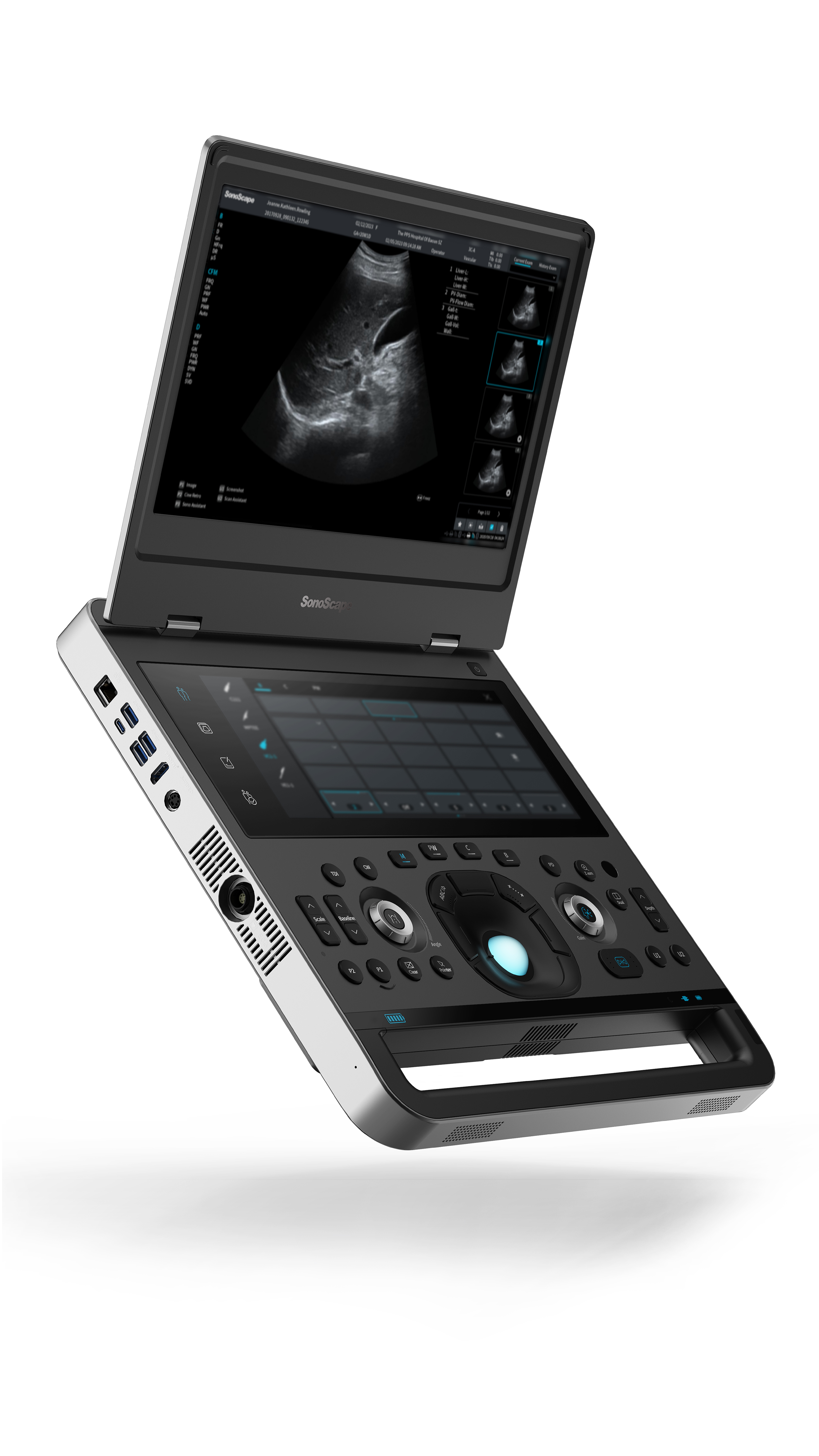 SonoScape Portable Ultrasound X-Series