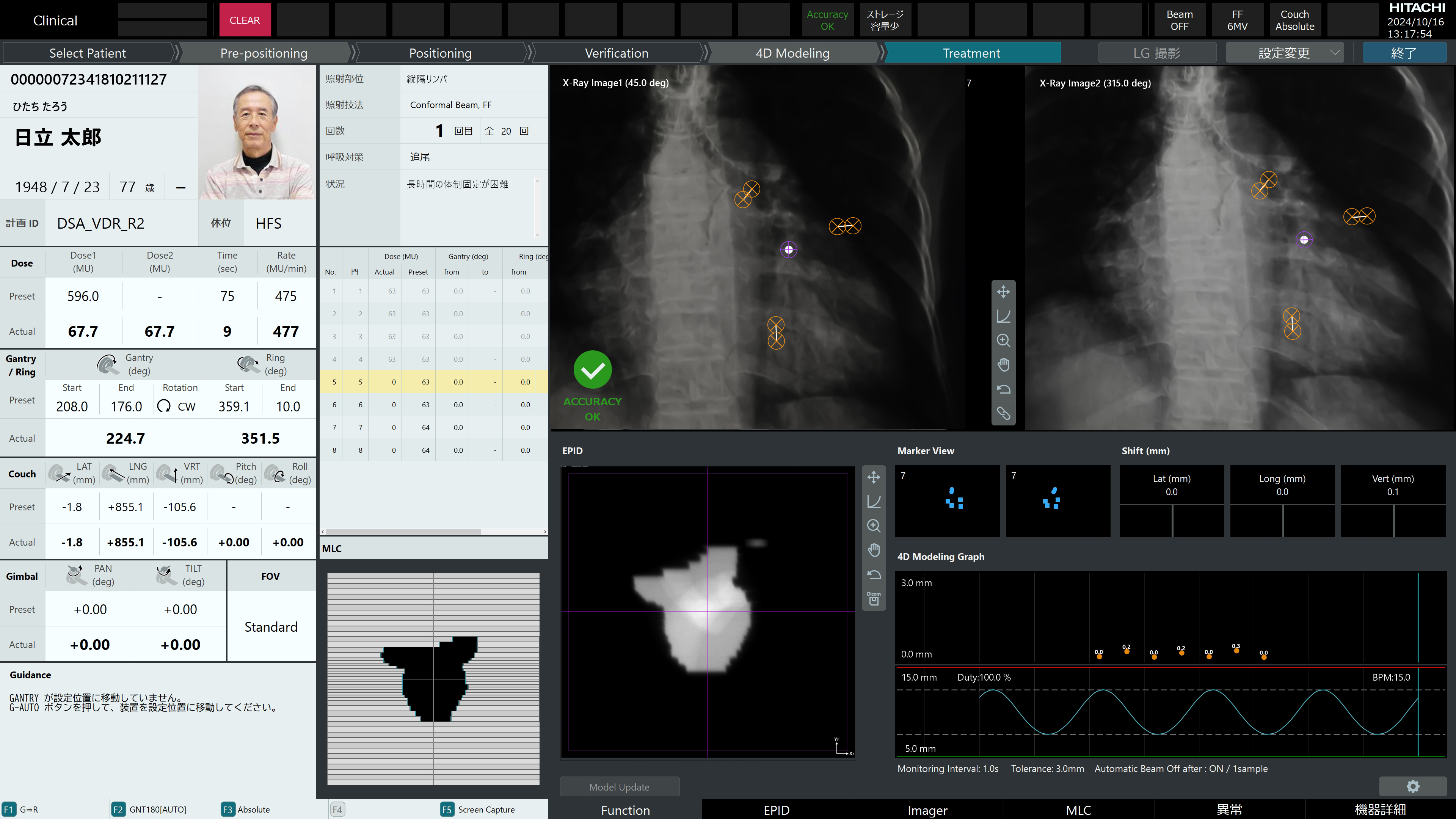 X-ray Treatment device OXRAY