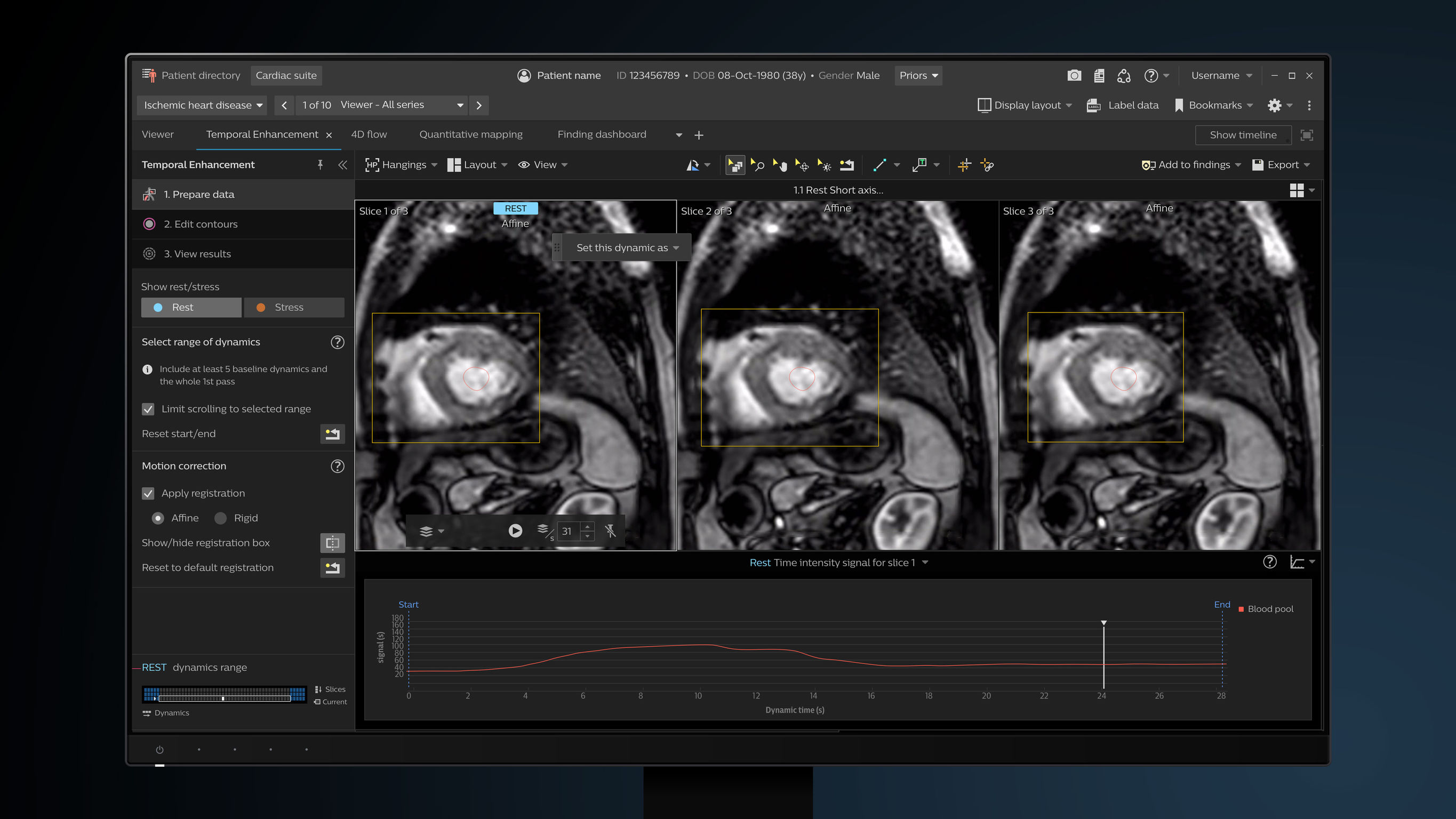 Philips IntelliSpace Portal Cardiac MR Suite