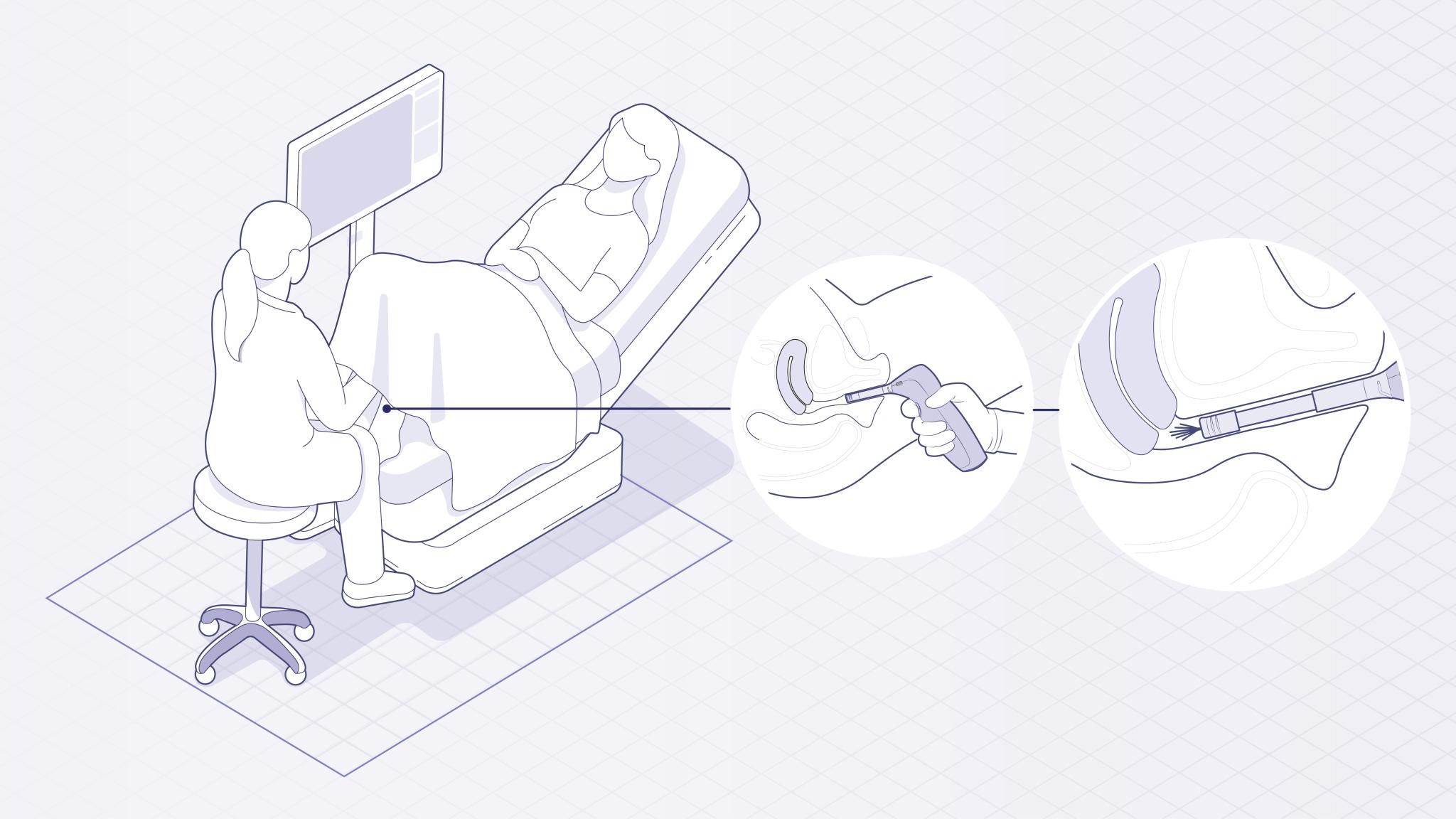 Forme - Cervical Screening Device